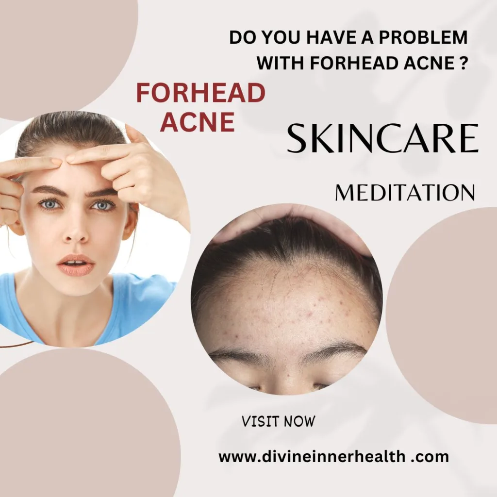 Forhead acne