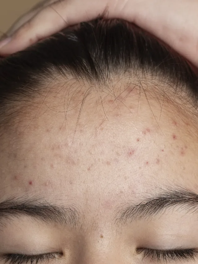 how to get rid of forehead acne